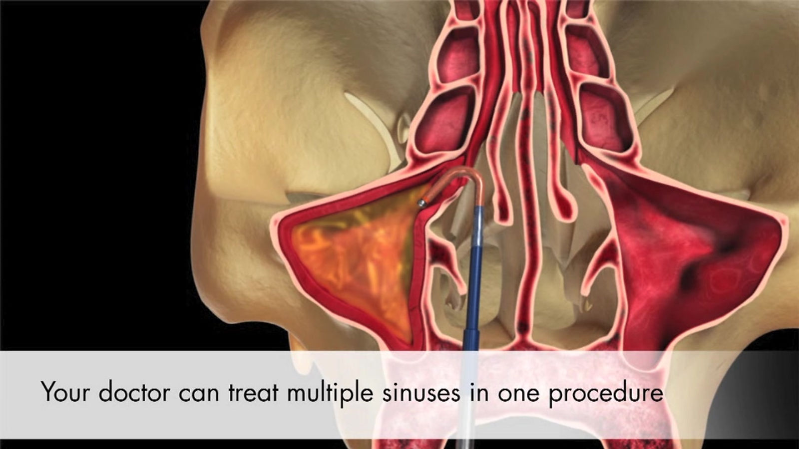 How XprESS Balloon Sinus Dilation Works